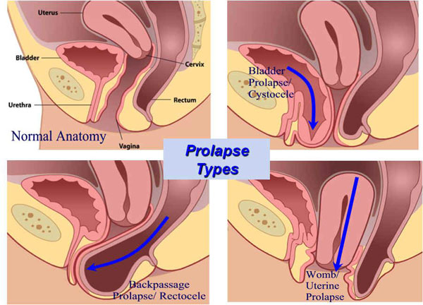 افتادگی رحم یا پروپلاس (Uterine Prolapse)